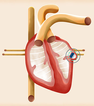 Watchman implant illustration.